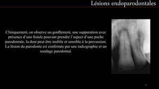 Lésions endoparodontales
Cliniquement, on observe un gonﬂement, une suppuration avec
présence d’une ﬁstule pouvant prendre l’aspect d’une poche
parodontale, la dent peut être mobile et sensible à la percussion.
La lésion du parodonte est conﬁrmée par une radiographie et un
sondage parodontal.
54
 