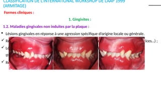 Classification des maladies parodontales | PPSX