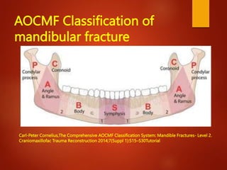 classificationfacialfracturekamini-200801184051.pptx