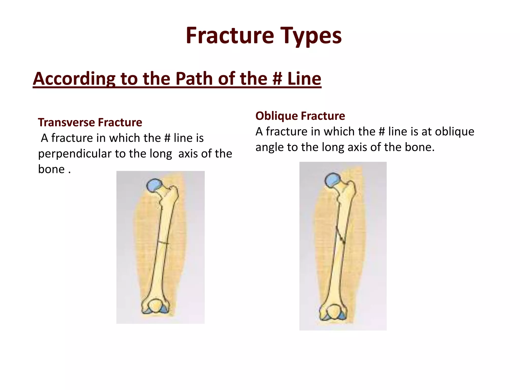 Transverse Fracture
A fracture in which the # line is
perpendicular to the long axis of the
bone .
Oblique Fracture
A fracture in which the # line is at oblique
angle to the long axis of the bone.
According to the Path of the # Line
Fracture Types
 