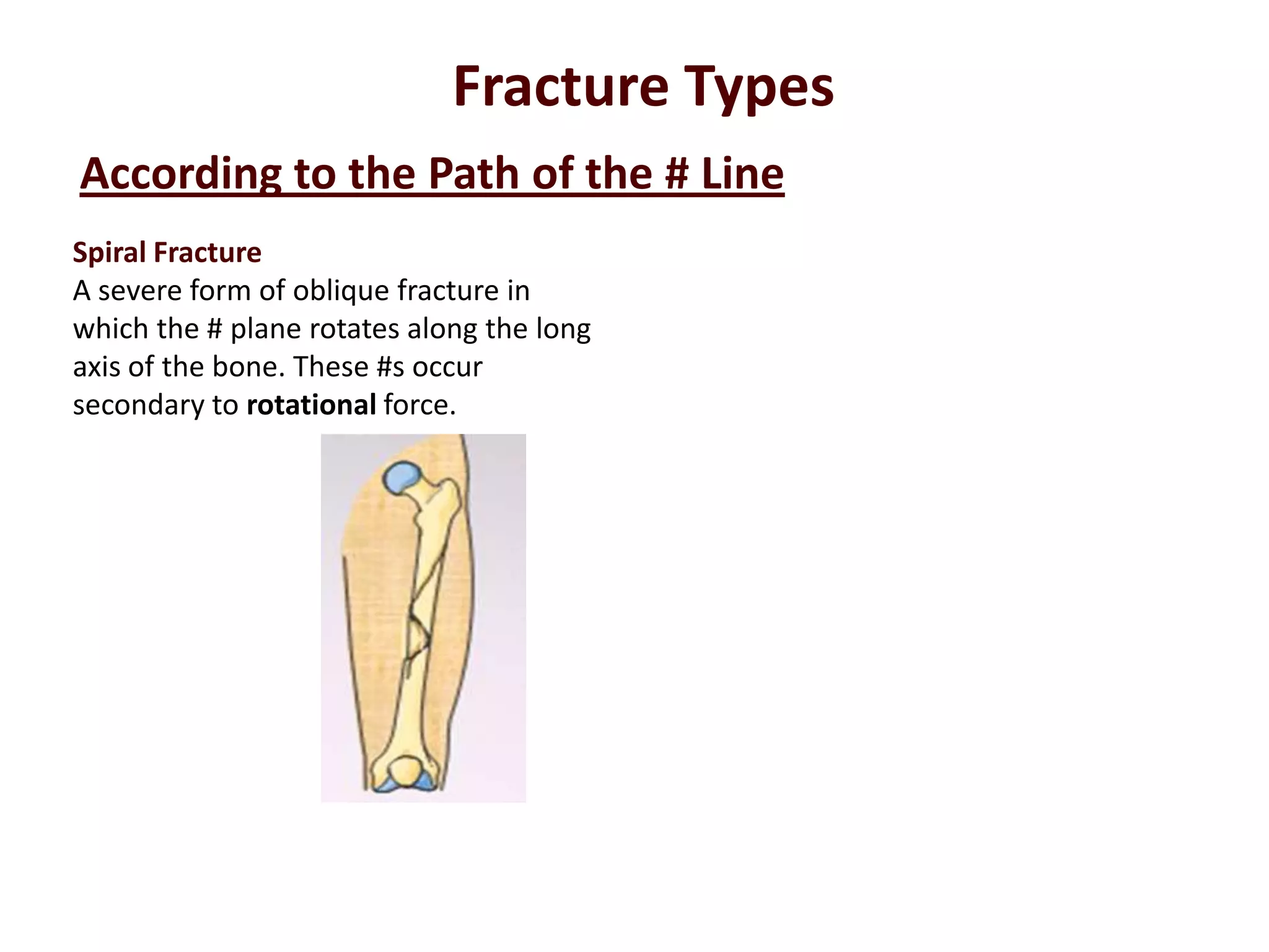 Spiral Fracture
A severe form of oblique fracture in
which the # plane rotates along the long
axis of the bone. These #s occur
secondary to rotational force.
According to the Path of the # Line
Fracture Types
 