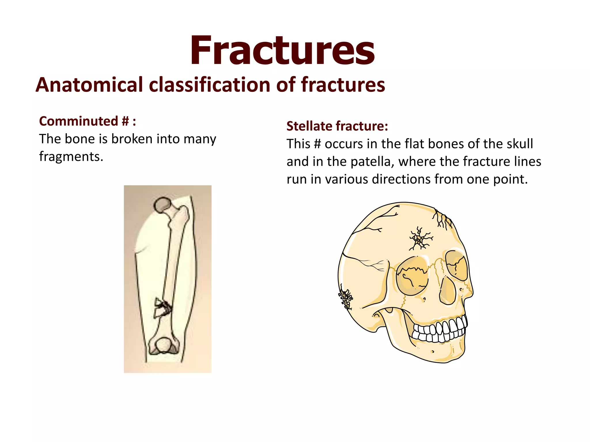 Anatomical classification of fractures
Fractures
Comminuted # :
The bone is broken into many
fragments.
Stellate fracture:
This # occurs in the flat bones of the skull
and in the patella, where the fracture lines
run in various directions from one point.
 