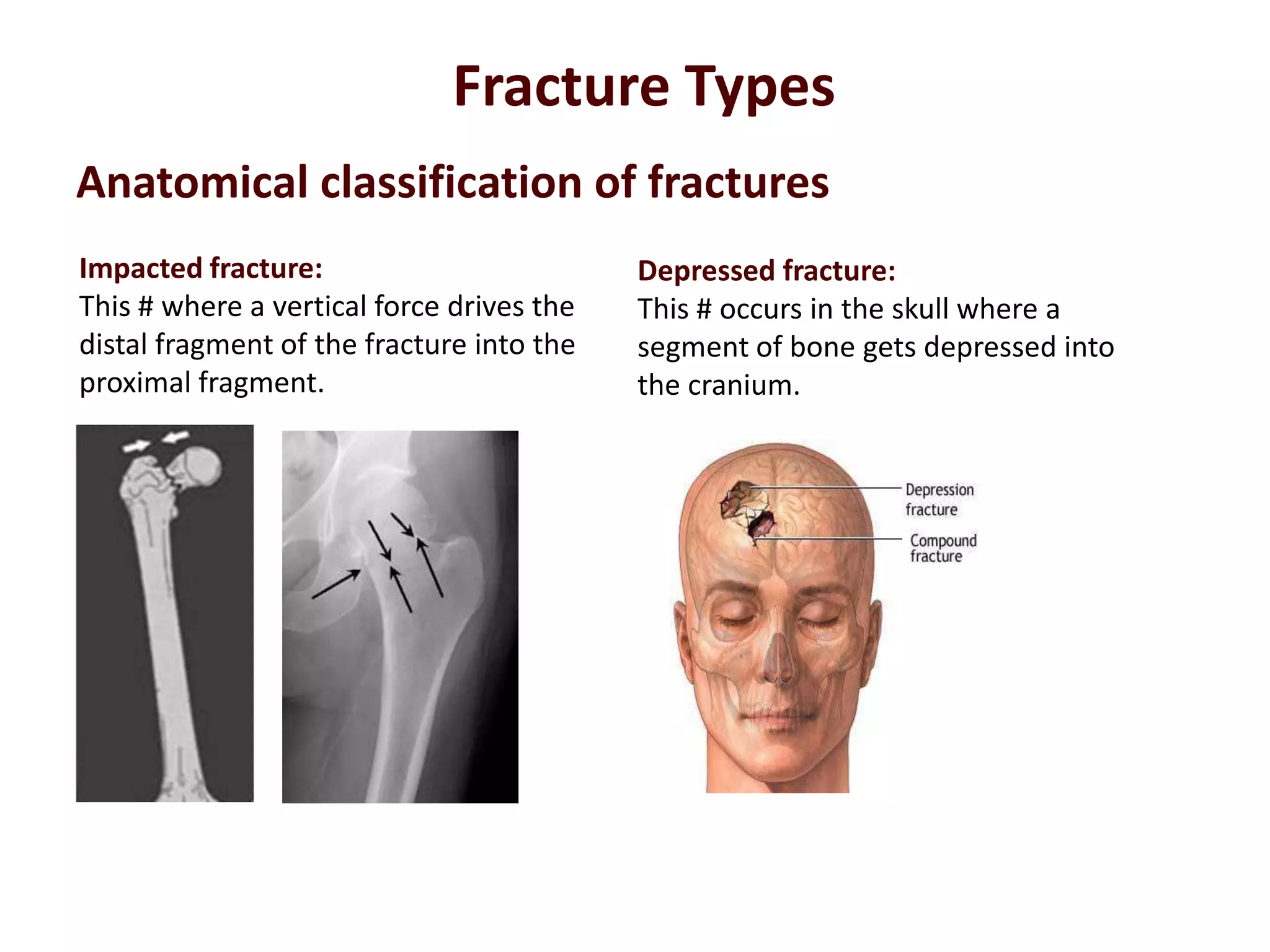 Anatomical classification of fractures
Impacted fracture:
This # where a vertical force drives the
distal fragment of the fracture into the
proximal fragment.
Fracture Types
Depressed fracture:
This # occurs in the skull where a
segment of bone gets depressed into
the cranium.
 