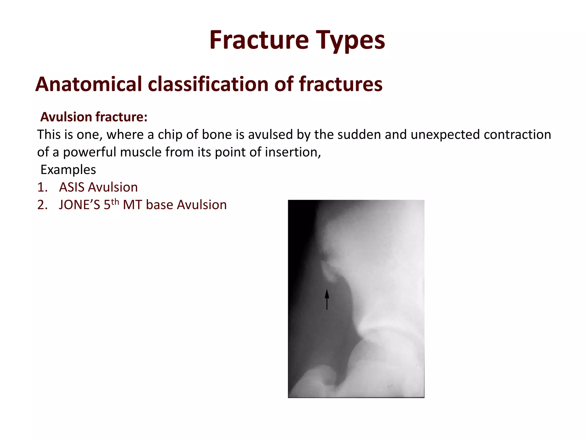 Avulsion fracture:
This is one, where a chip of bone is avulsed by the sudden and unexpected contraction
of a powerful muscle from its point of insertion,
Examples
1. ASIS Avulsion
2. JONE’S 5th MT base Avulsion
Fracture Types
Anatomical classification of fractures
 
