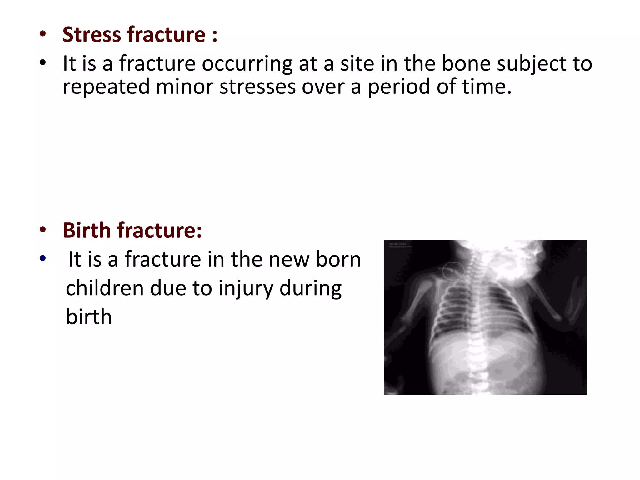 • Stress fracture :
• It is a fracture occurring at a site in the bone subject to
repeated minor stresses over a period of time.
• Birth fracture:
• It is a fracture in the new born
children due to injury during
birth
 