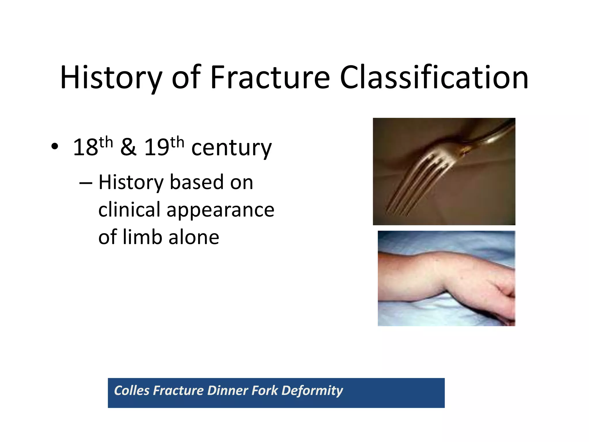 History of Fracture Classification
• 18th & 19th century
– History based on
clinical appearance
of limb alone
Colles Fracture Dinner Fork Deformity
 