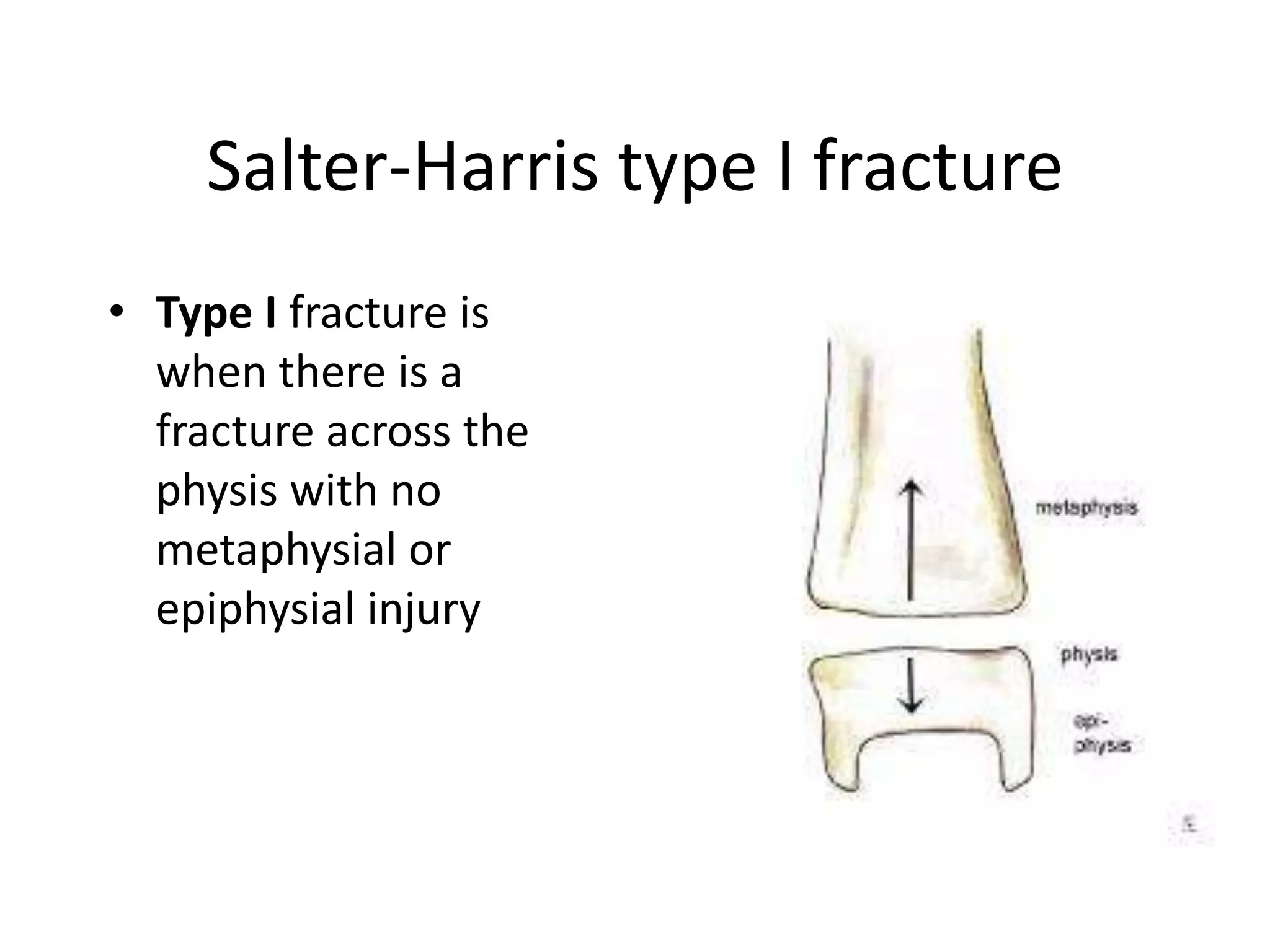 Salter-Harris type I fracture
• Type I fracture is
when there is a
fracture across the
physis with no
metaphysial or
epiphysial injury
 