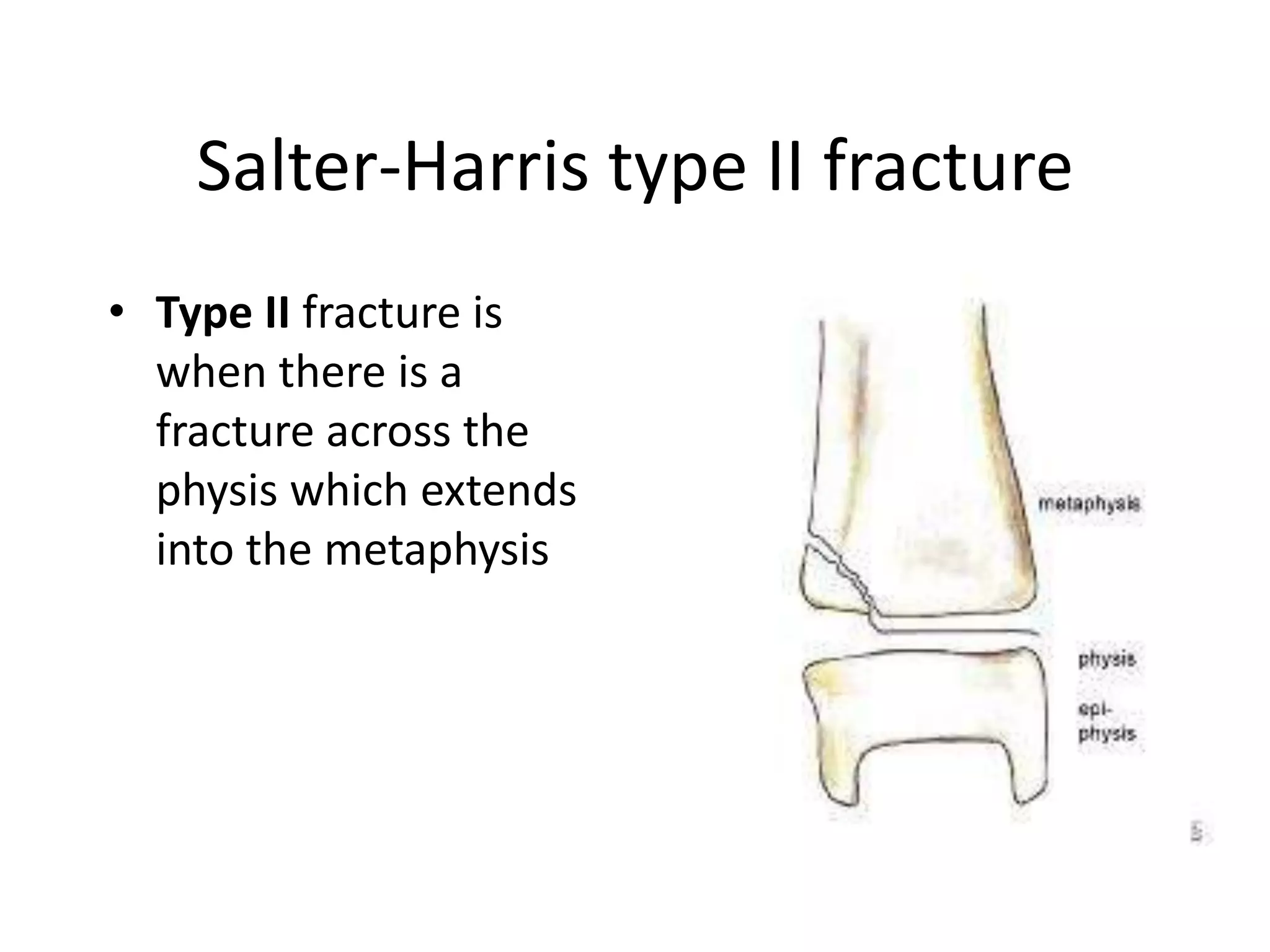 Salter-Harris type II fracture
• Type II fracture is
when there is a
fracture across the
physis which extends
into the metaphysis
 