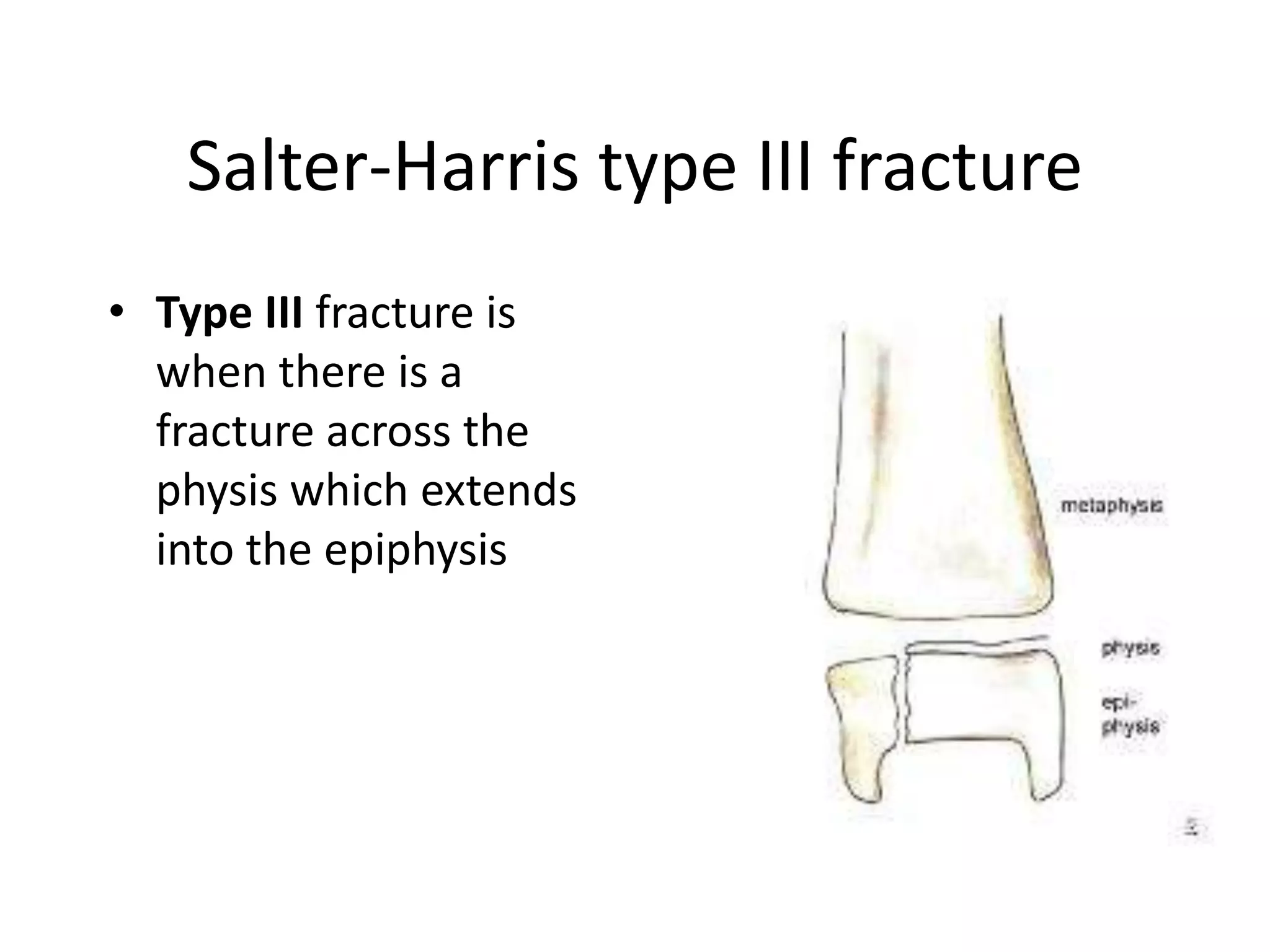 Salter-Harris type III fracture
• Type III fracture is
when there is a
fracture across the
physis which extends
into the epiphysis
 