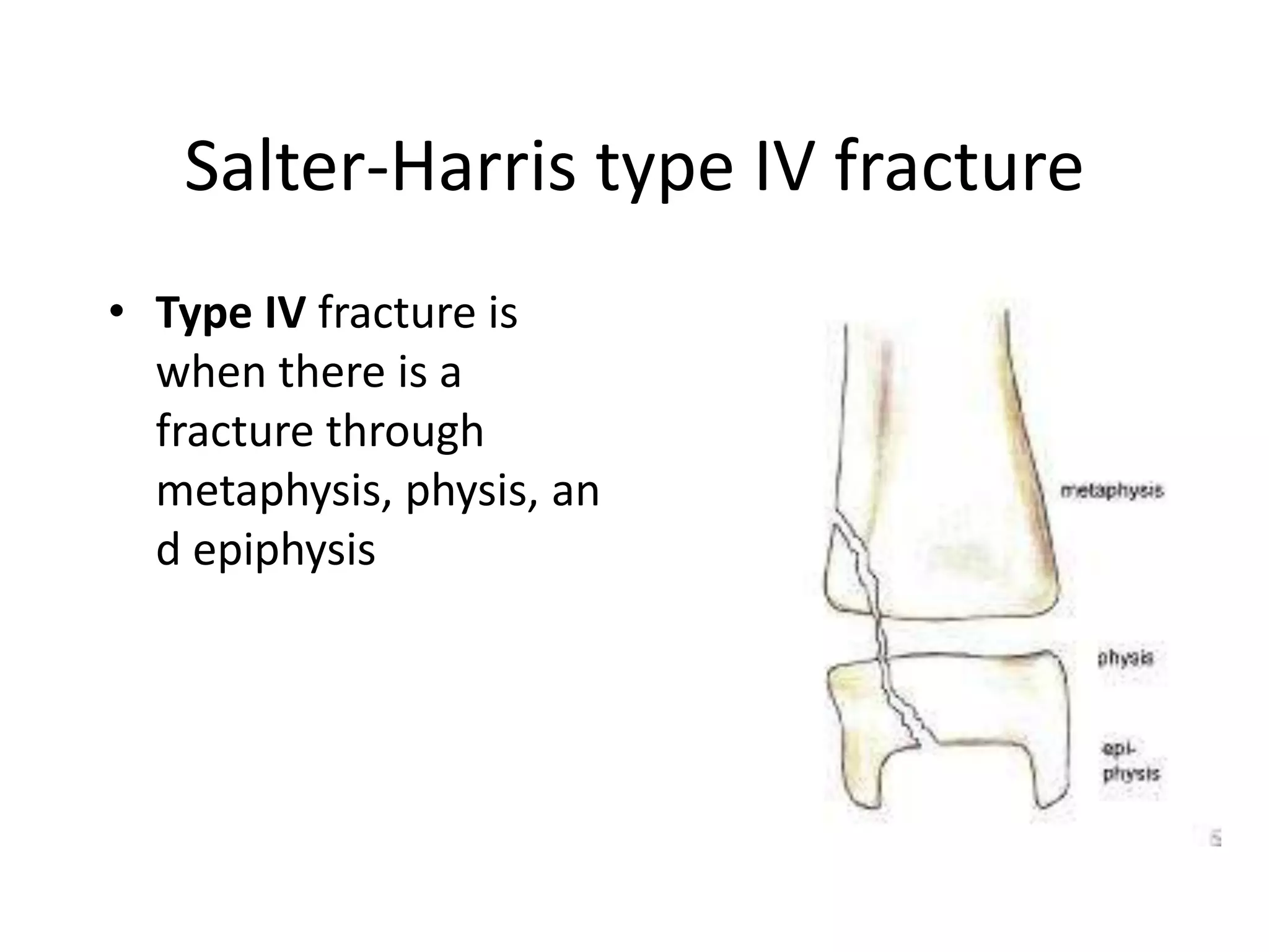 Salter-Harris type IV fracture
• Type IV fracture is
when there is a
fracture through
metaphysis, physis, an
d epiphysis
 
