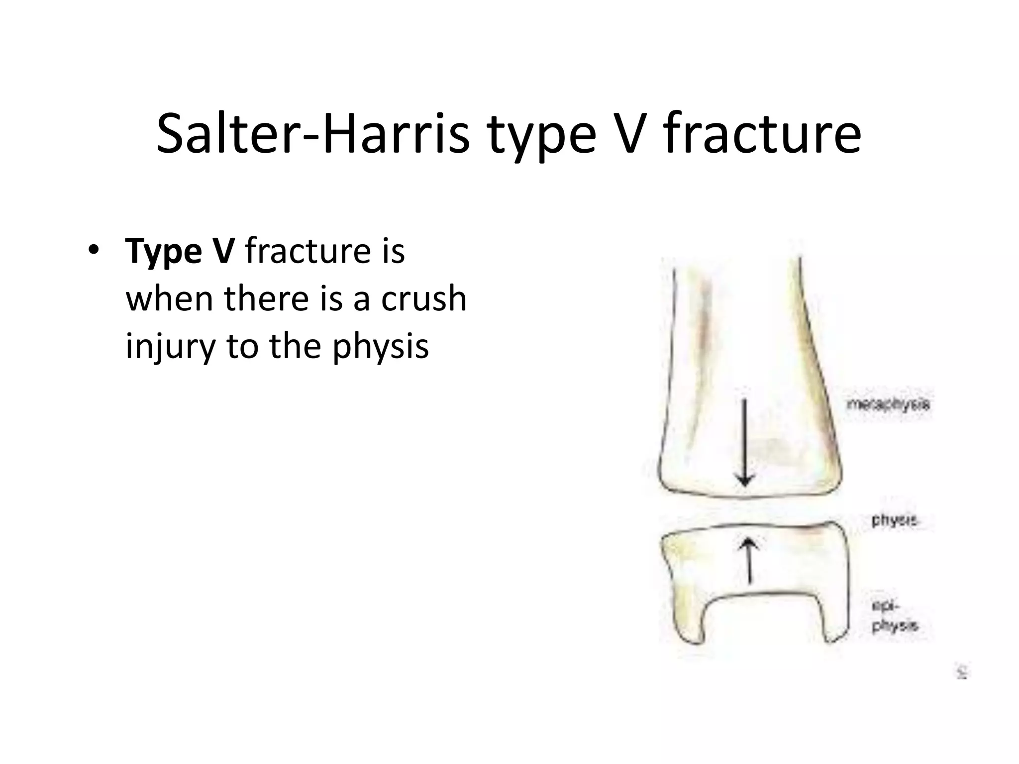 Salter-Harris type V fracture
• Type V fracture is
when there is a crush
injury to the physis
 