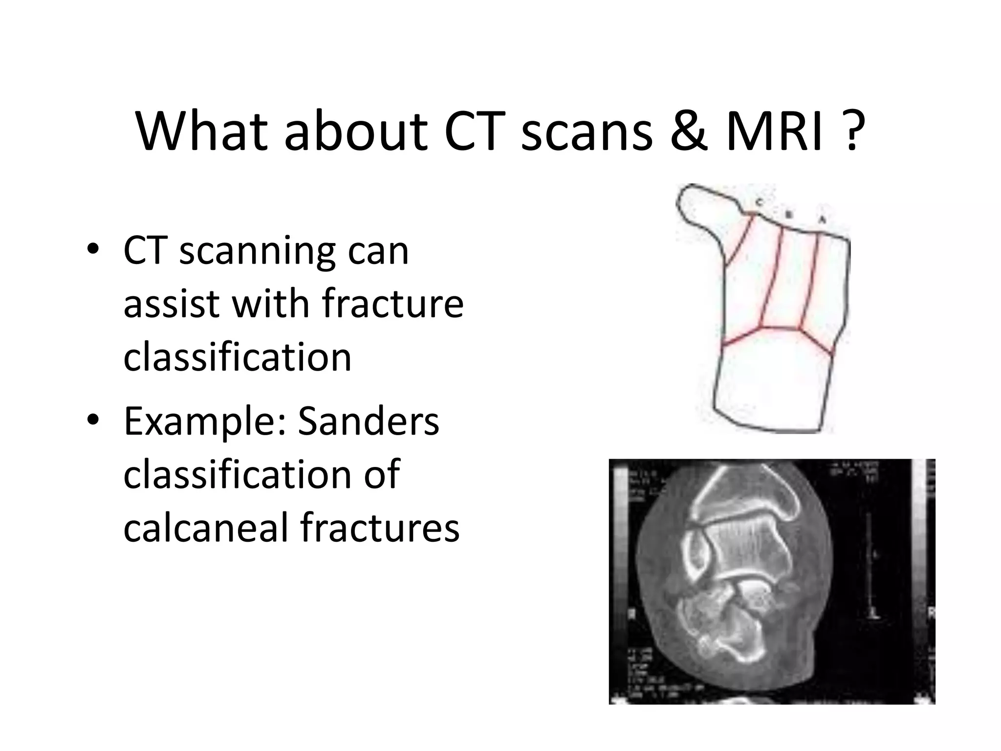 What about CT scans & MRI ?
• CT scanning can
assist with fracture
classification
• Example: Sanders
classification of
calcaneal fractures
 