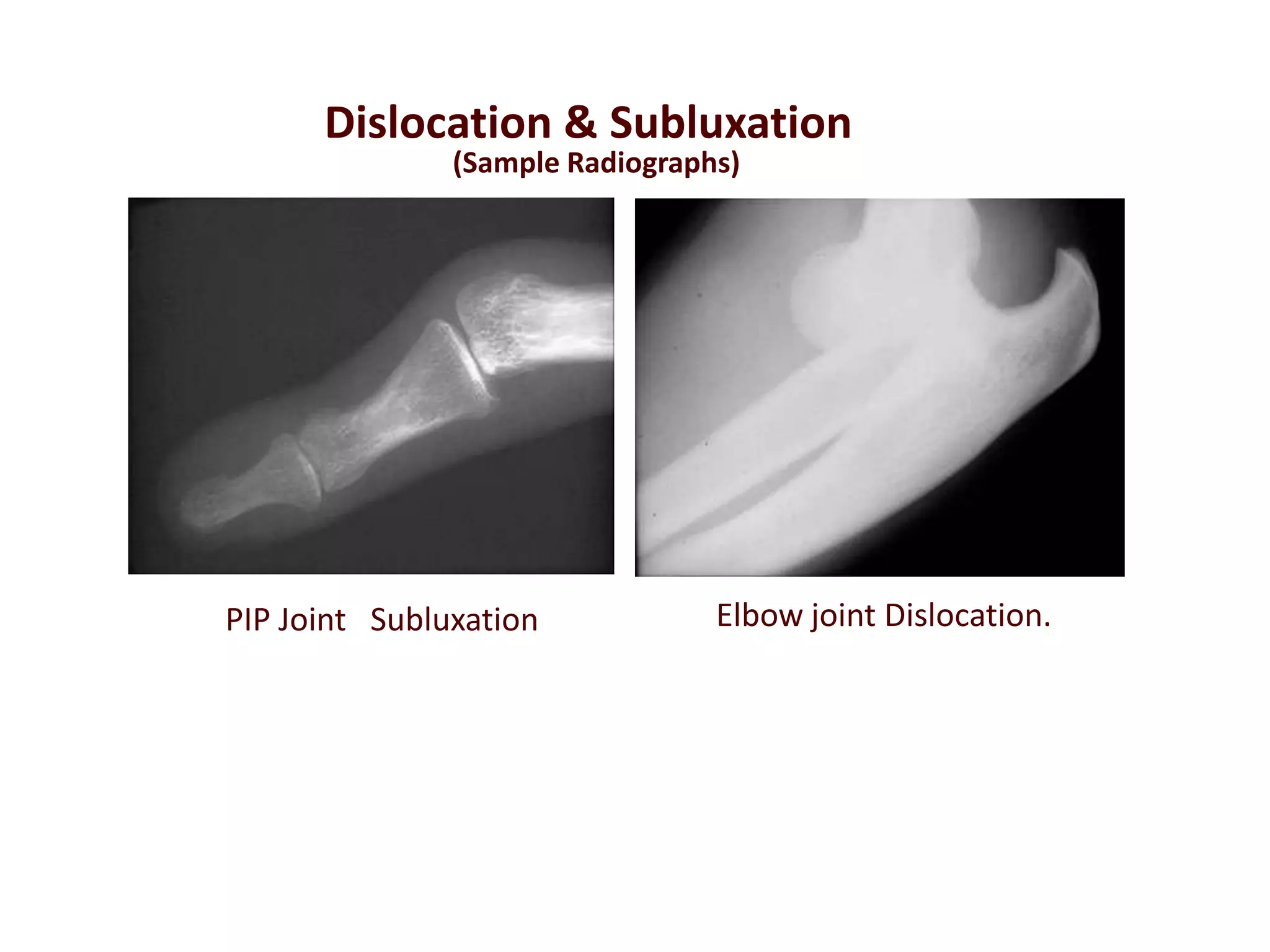 PIP Joint Subluxation Elbow joint Dislocation.
Dislocation & Subluxation
(Sample Radiographs)
 