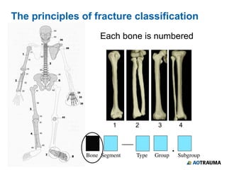 Fracture Rate Classification classification of fractures&$&$$$)$.pptx