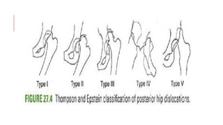 Classification of acetabular fractures