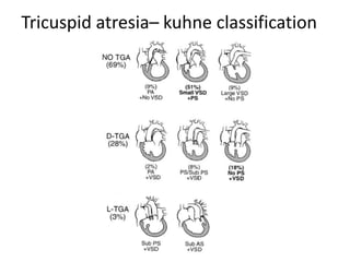 Tricuspid atresia– kuhne classification
 