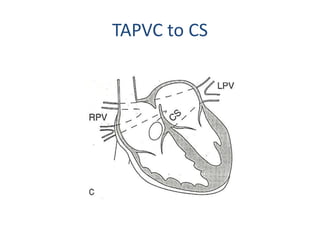 TAPVC to CS
 