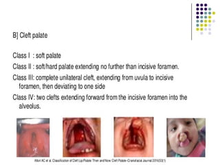 CLASSIFICATION OF CLEFT LIP & CLEFT PALATE, AND THEIR PROSTHODONTIC ...