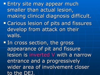Entry site may appear much smaller than actual lesion, making clinical diagnosis difficult. Carious lesion of pits and fissures develop from attack on their walls. In cross section, the gross appearance of pit and fissure lesion is  inverted V  with a narrow entrance and a progressively wider area of involvement closer to the DEJ . 