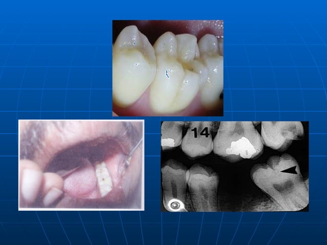 Classification Of Dental Caries | PPT
