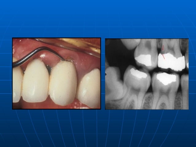 Classification Of Dental Caries | PPT
