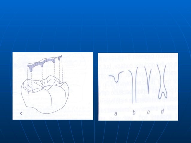 Classification Of Dental Caries | PPT