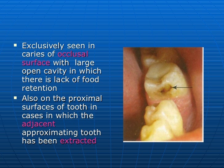 Classification Of Dental Caries