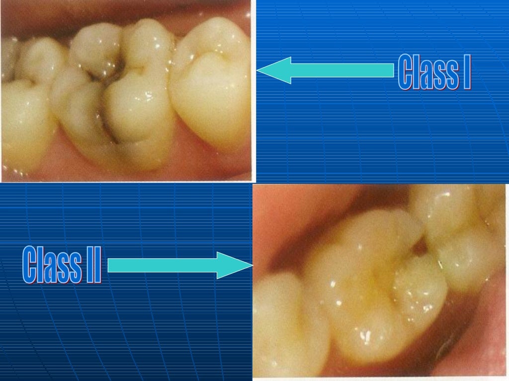 Classification Of Dental Caries