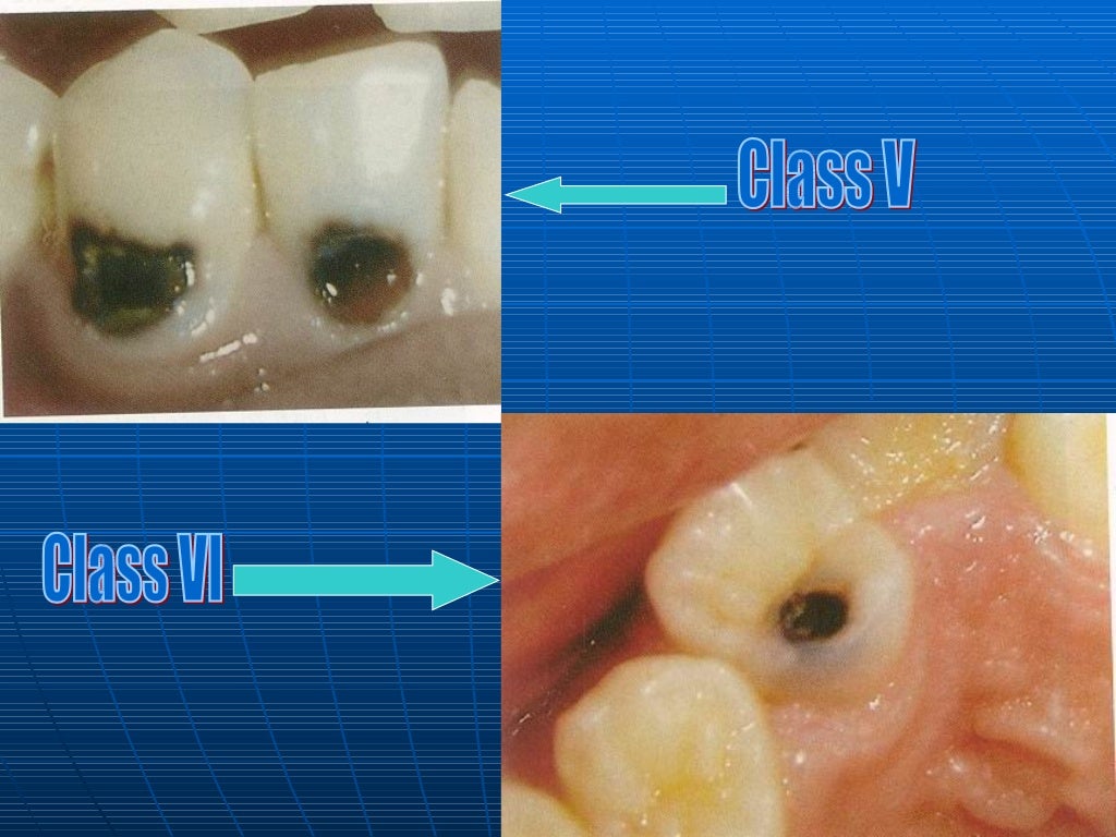 Classification Of Dental Caries