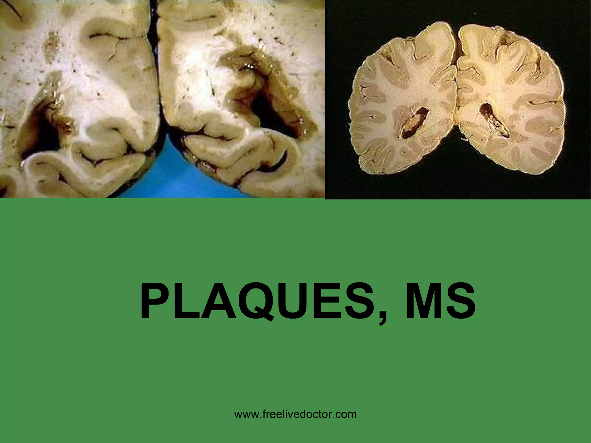 PLAQUES, MS www.freelivedoctor.com 