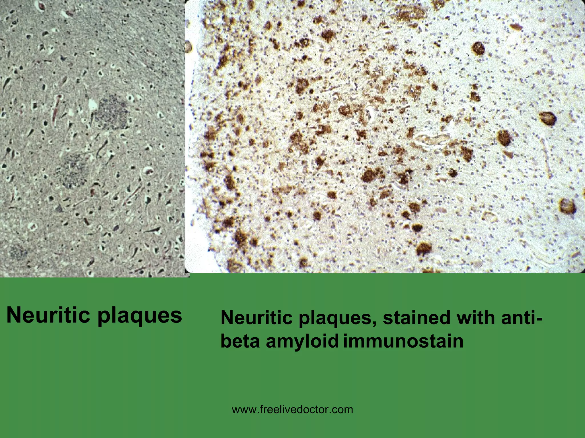 Neuritic plaques Neuritic plaques, stained with anti- beta amyloid   immunostain www.freelivedoctor.com 