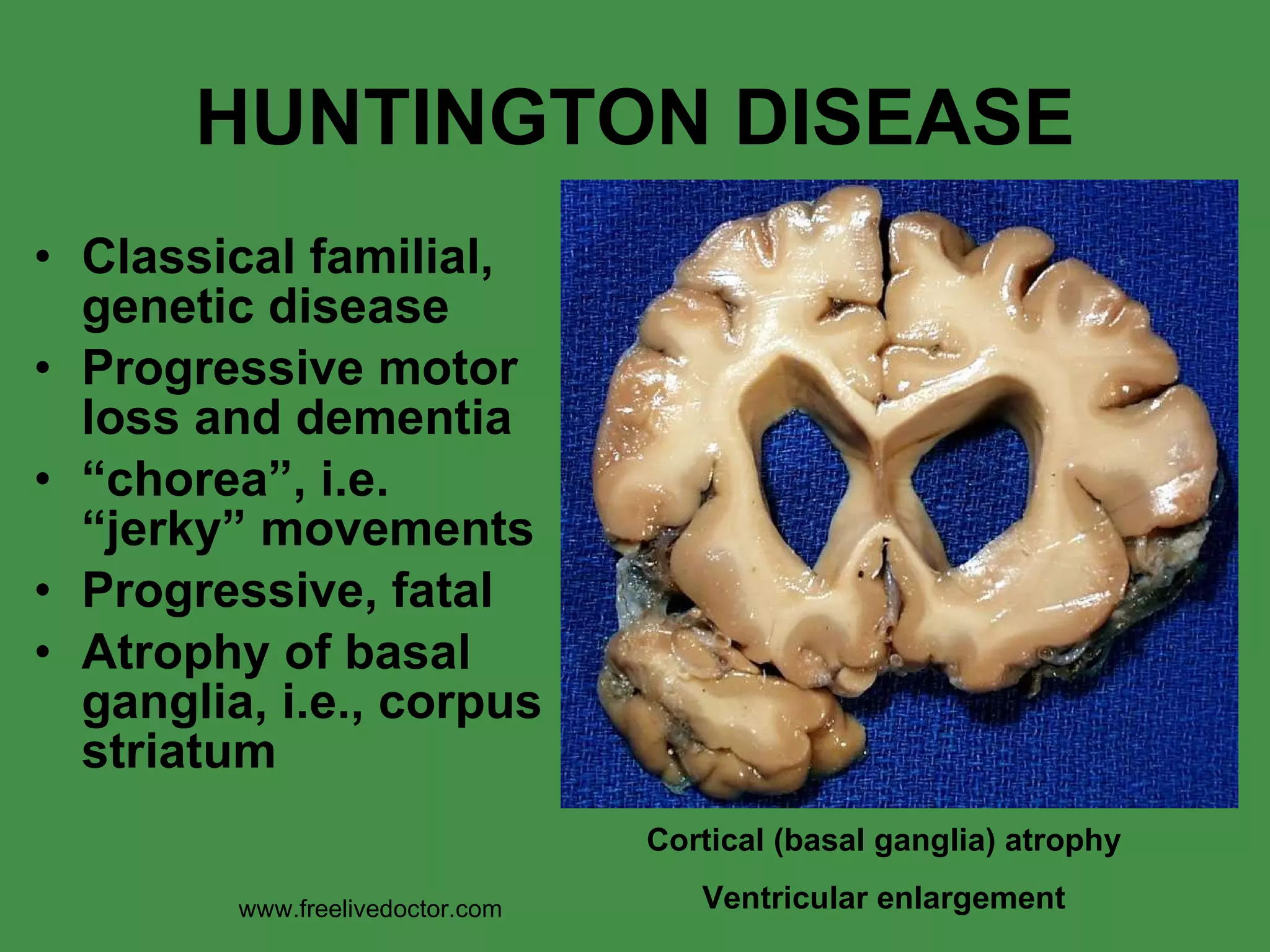 HUNTINGTON DISEASE Classical familial, genetic disease Progressive motor loss and dementia “ chorea”, i.e. “jerky” movements Progressive, fatal Atrophy of basal ganglia, i.e., corpus striatum Cortical (basal ganglia) atrophy Ventricular enlargement www.freelivedoctor.com 
