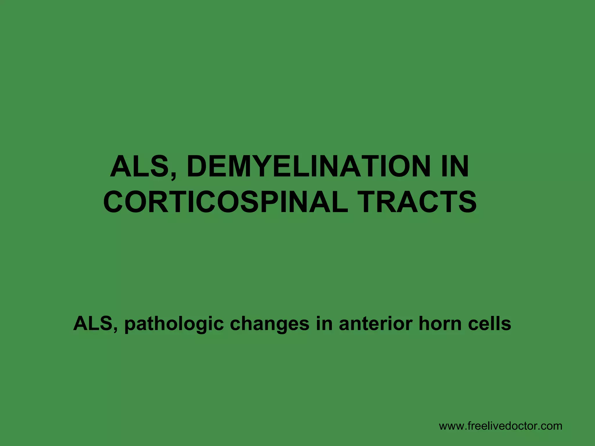 ALS, DEMYELINATION IN CORTICOSPINAL TRACTS ALS, pathologic changes in anterior horn cells www.freelivedoctor.com 