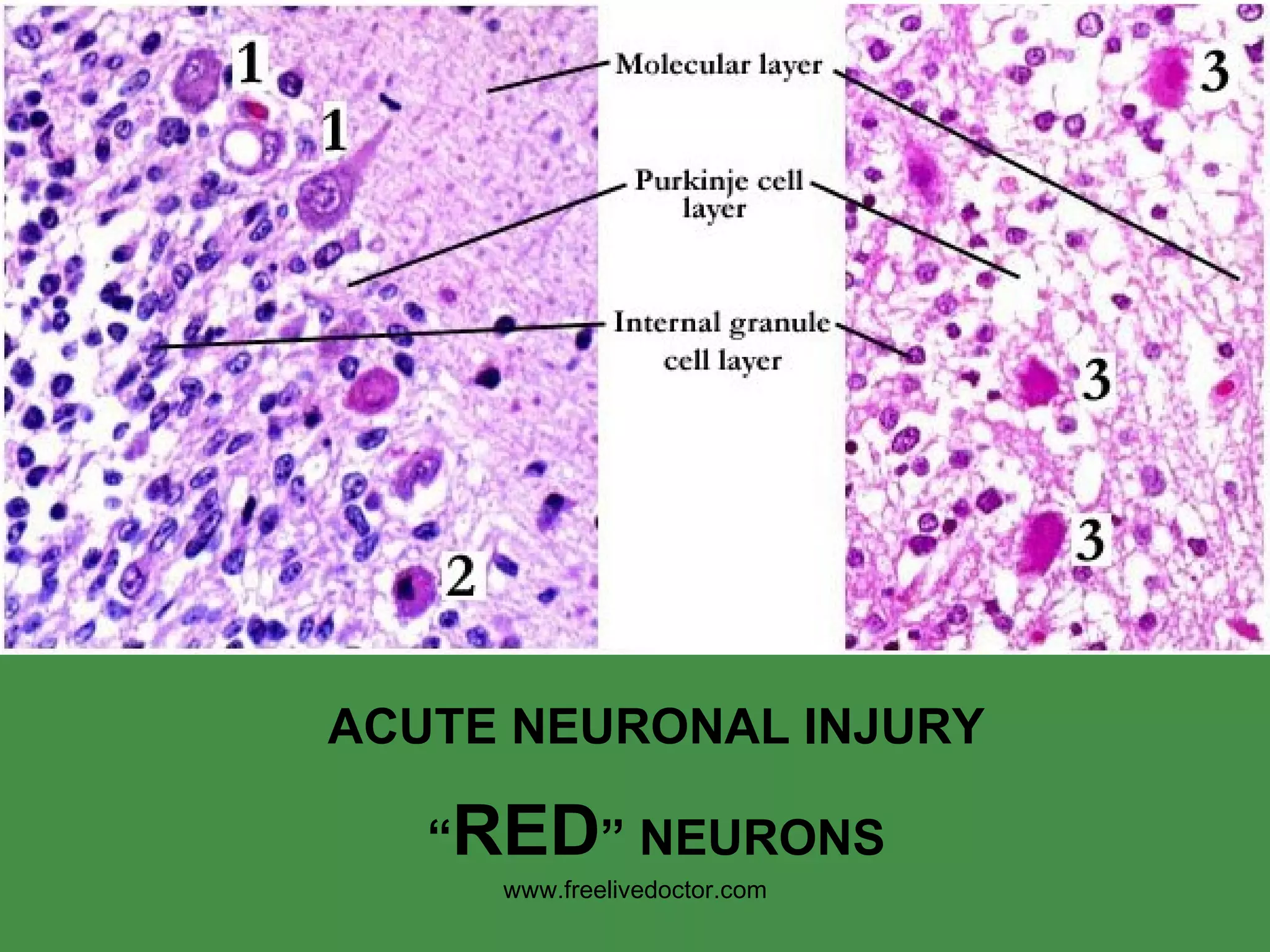 ACUTE NEURONAL INJURY “ RED ” NEURONS www.freelivedoctor.com 