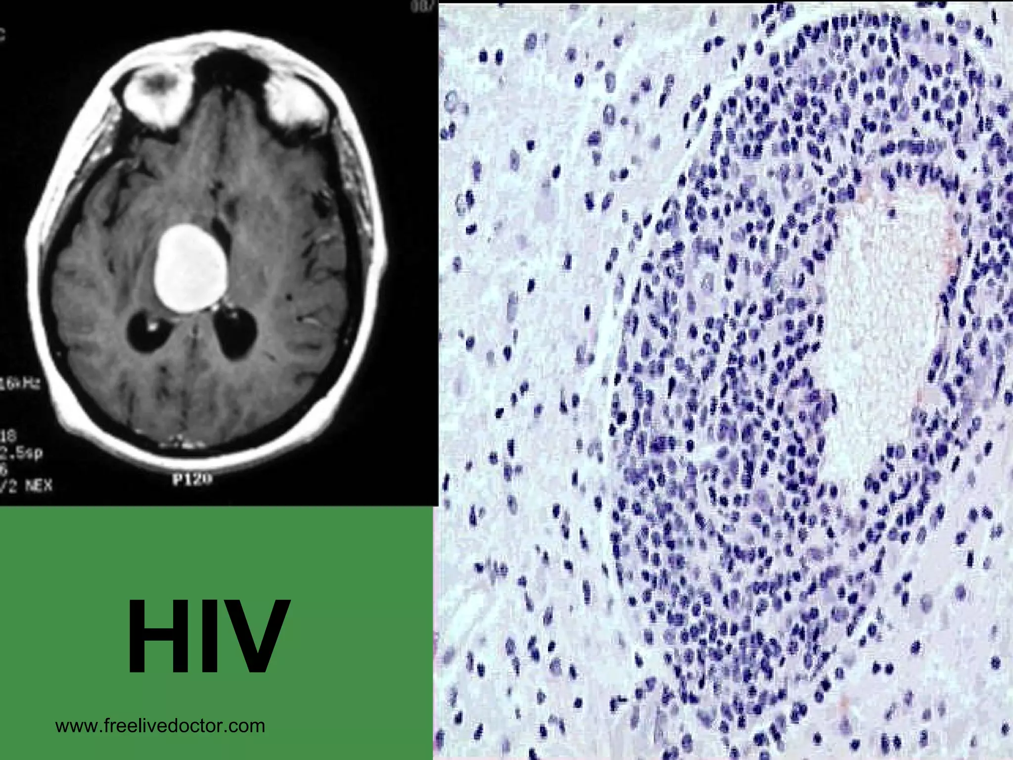 HIV www.freelivedoctor.com 