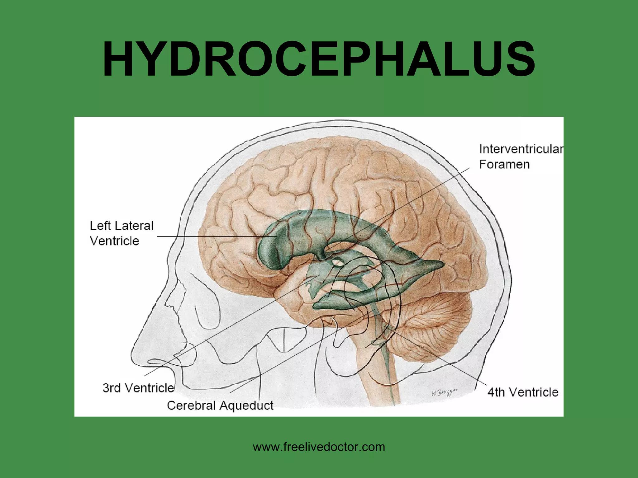HYDROCEPHALUS www.freelivedoctor.com 