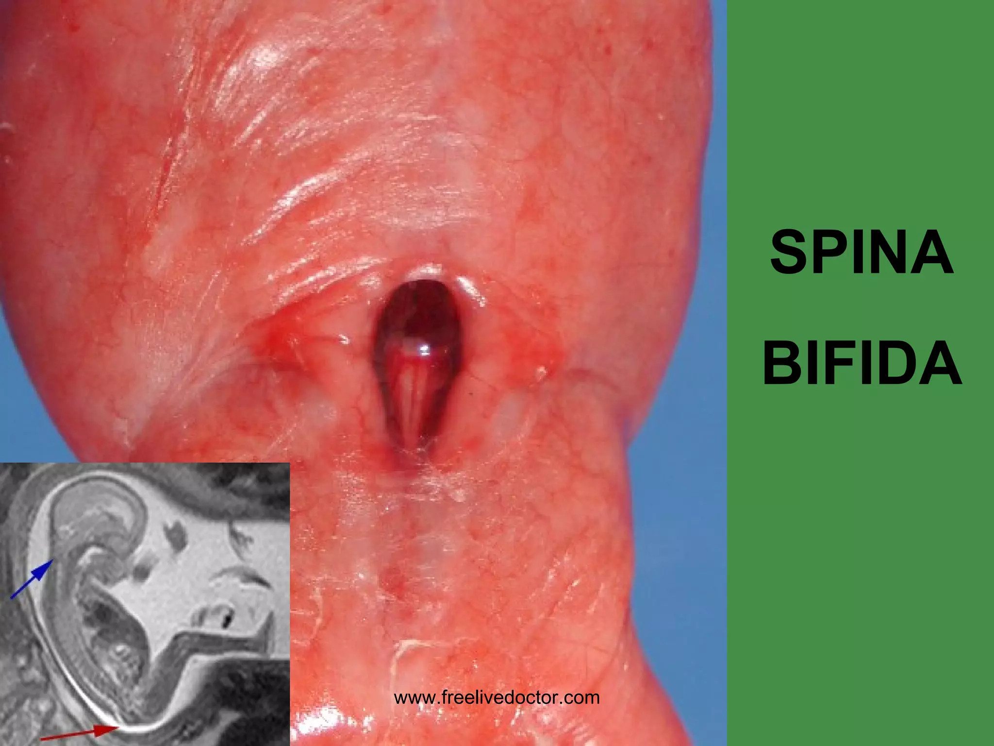 SPINA BIFIDA www.freelivedoctor.com 