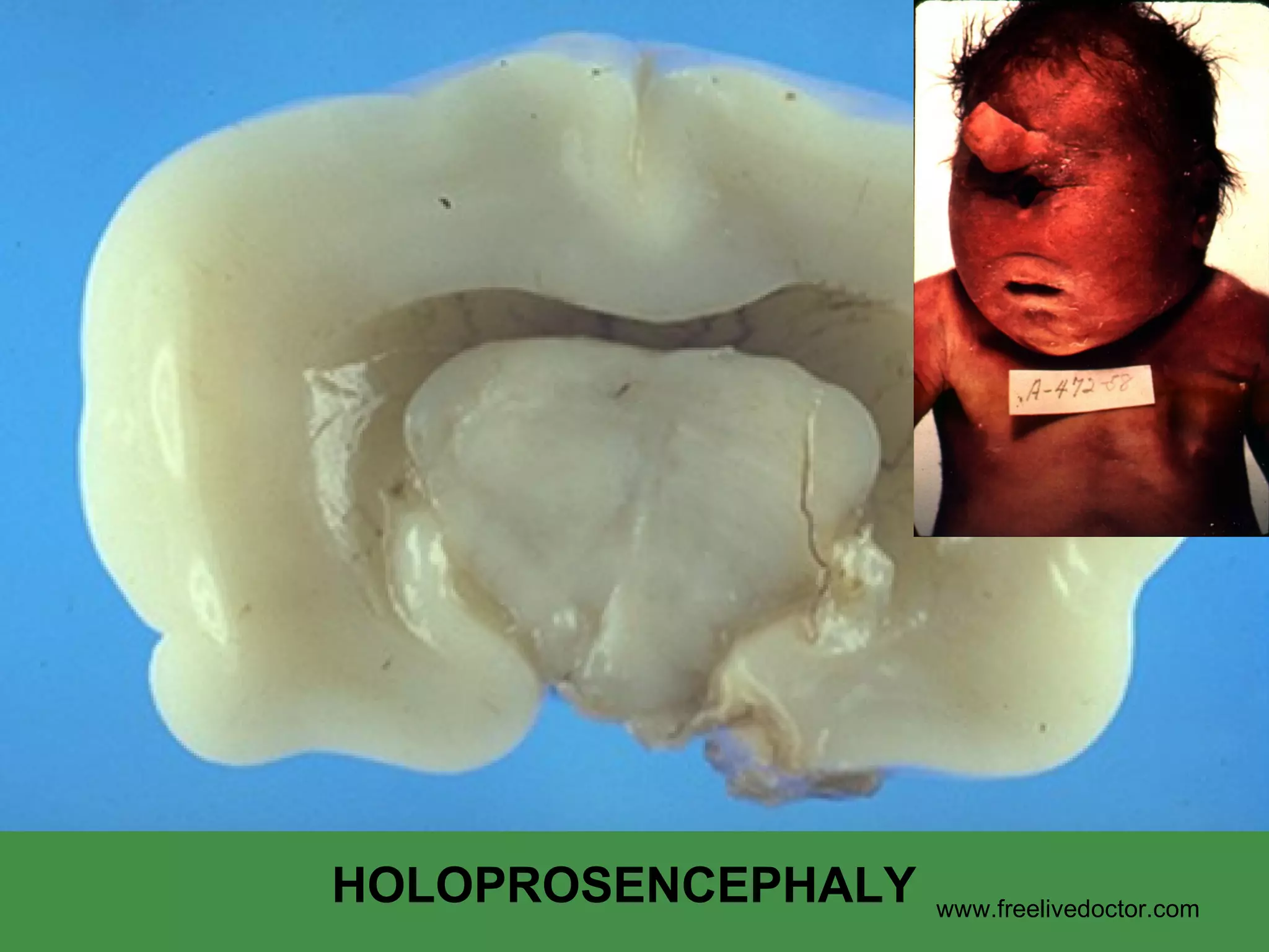 HOLOPROSENCEPHALY www.freelivedoctor.com 