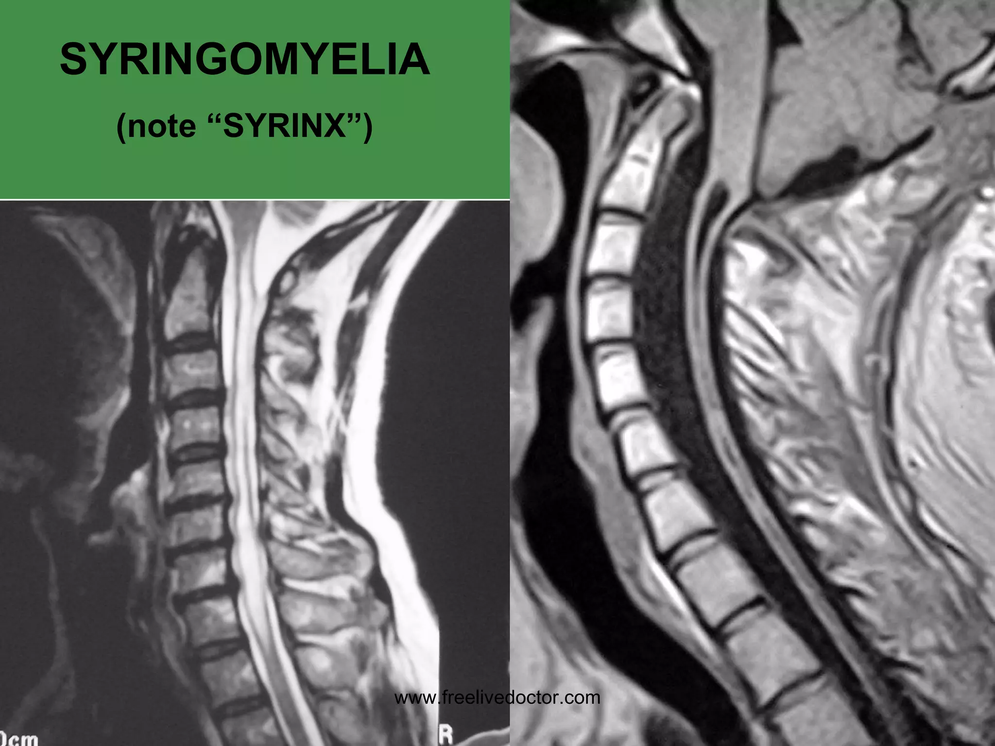 SYRINGOMYELIA (note “SYRINX”) www.freelivedoctor.com 