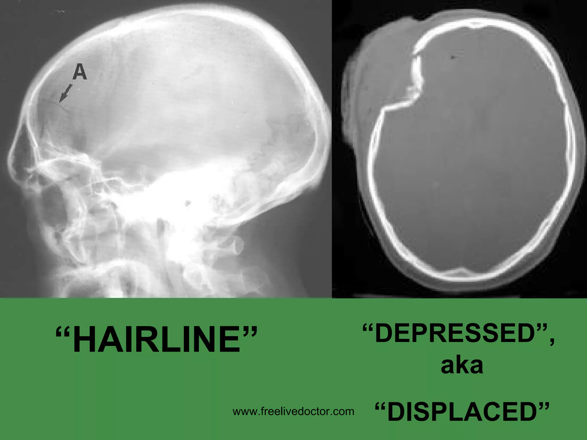 “ HAIRLINE” “ DEPRESSED”,  aka “ DISPLACED” www.freelivedoctor.com 