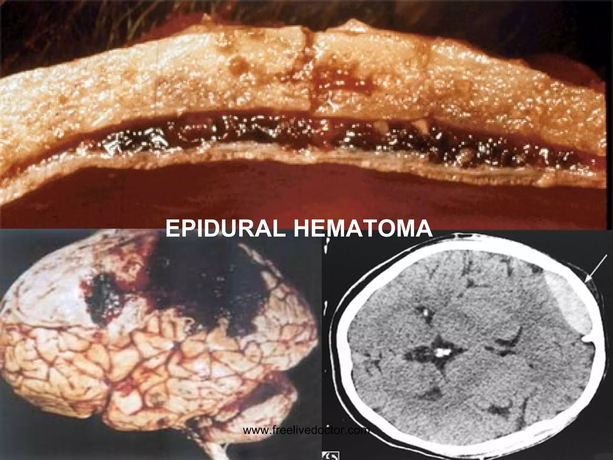 EPIDURAL HEMATOMA www.freelivedoctor.com 