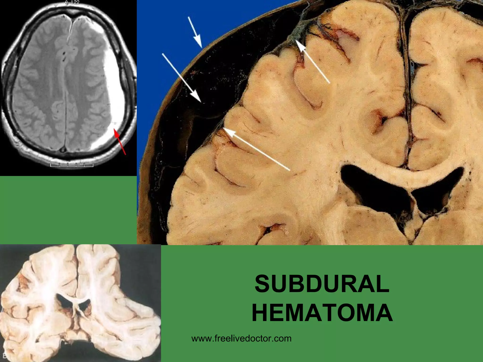 SUBDURAL HEMATOMA www.freelivedoctor.com 