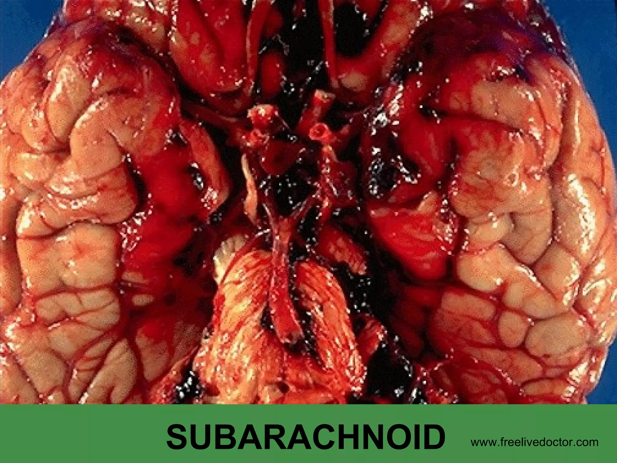 SUBARACHNOID www.freelivedoctor.com 