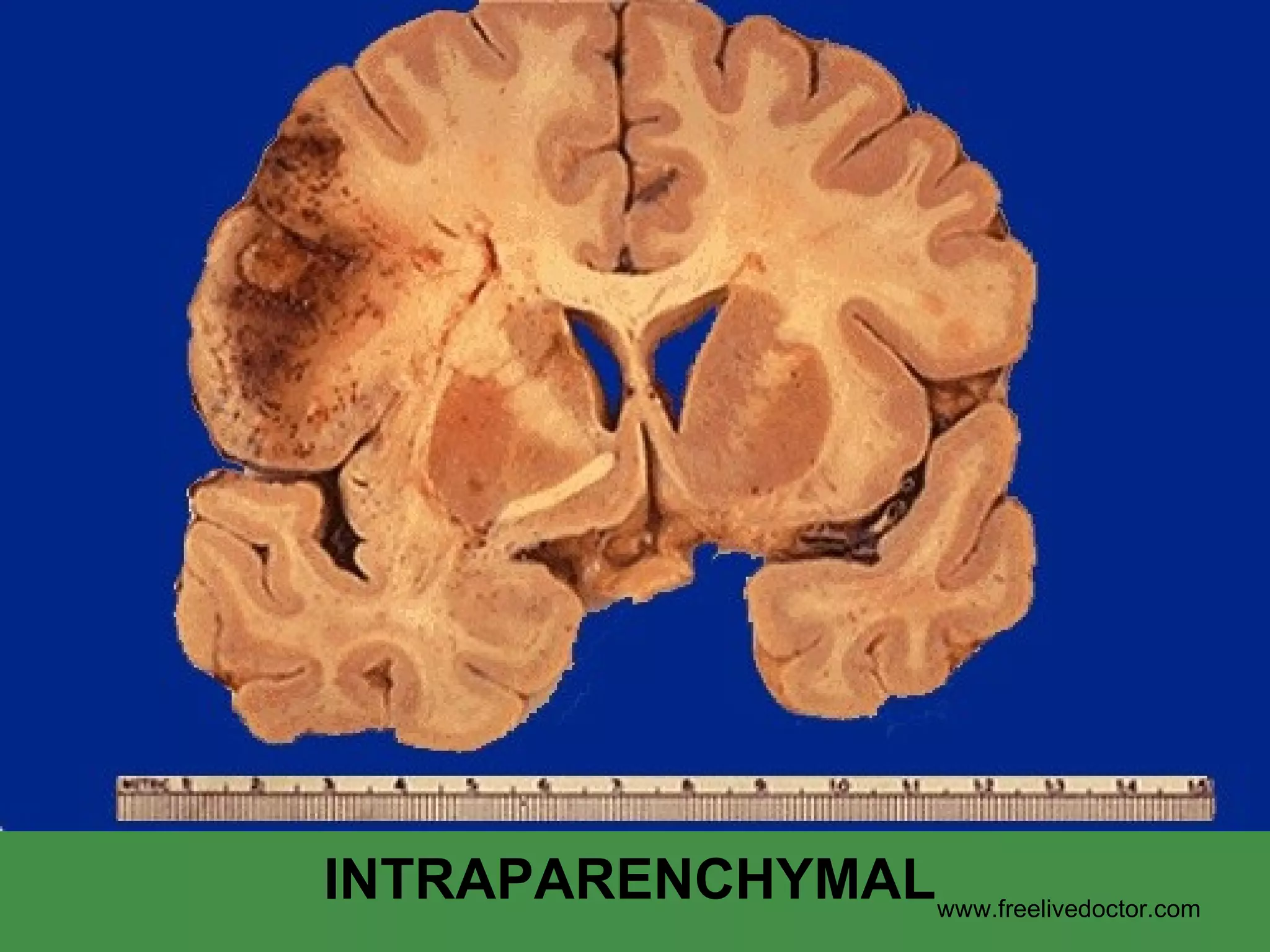 INTRAPARENCHYMAL www.freelivedoctor.com 