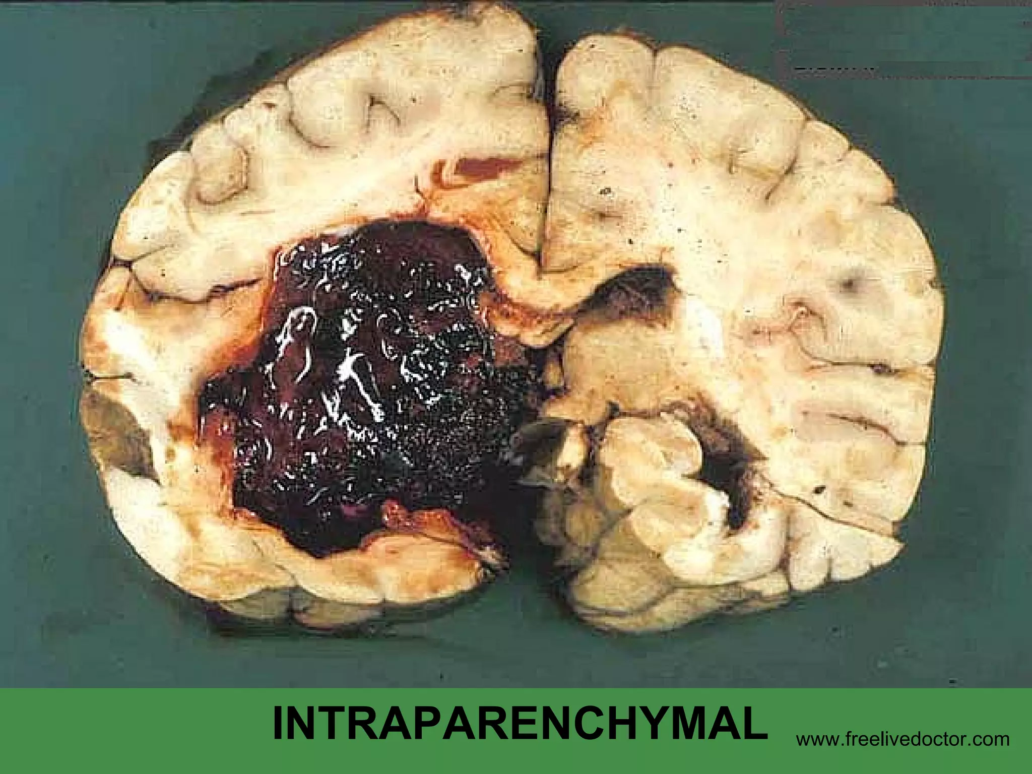INTRAPARENCHYMAL www.freelivedoctor.com 