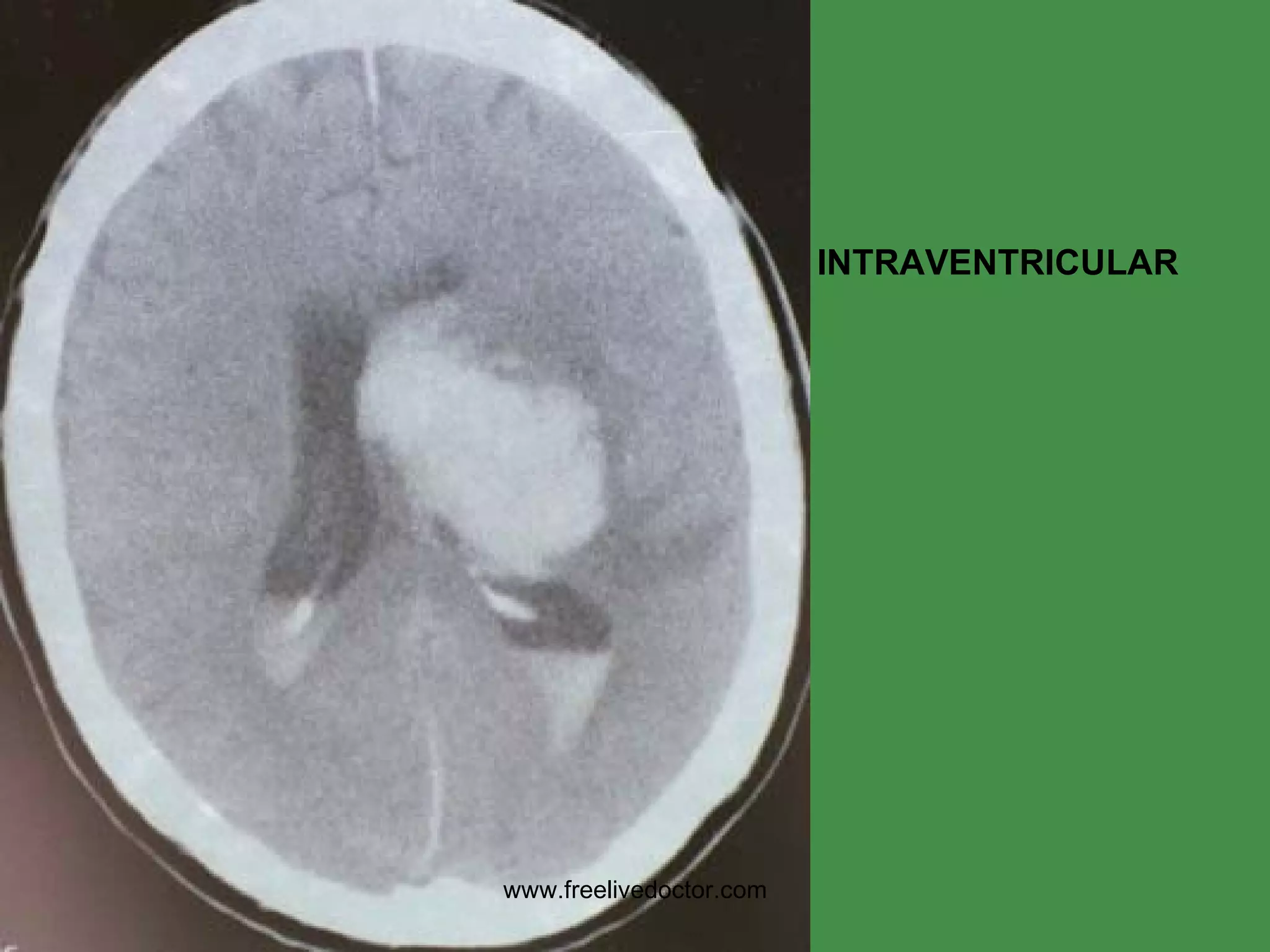 INTRAVENTRICULAR www.freelivedoctor.com 