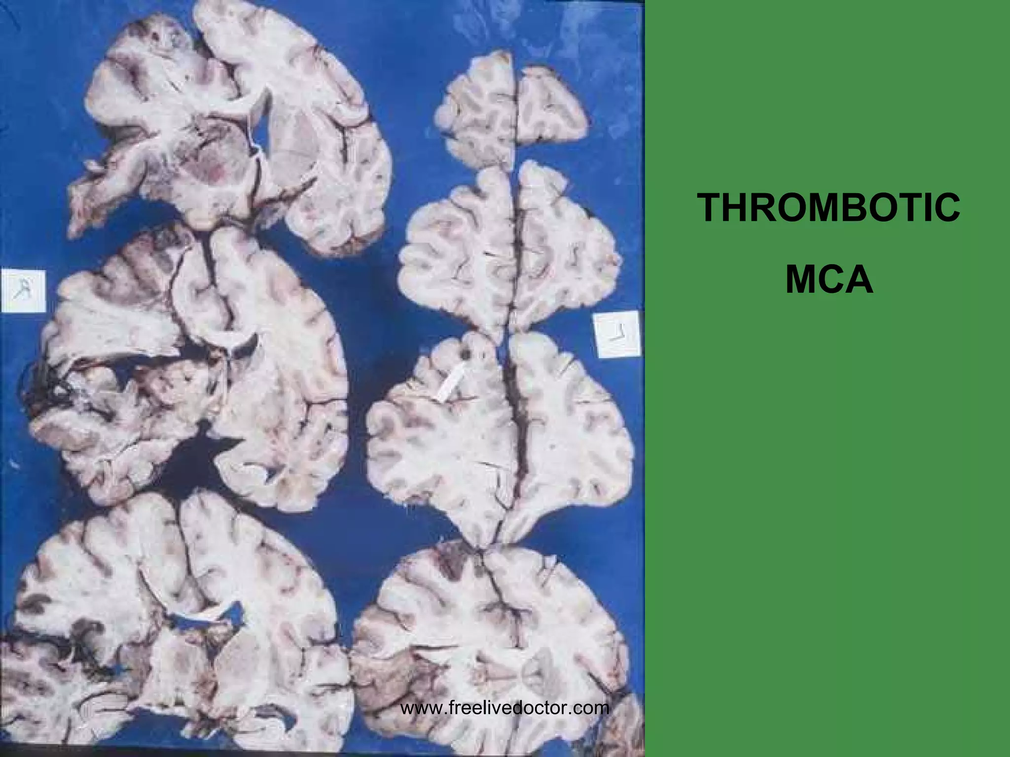 THROMBOTIC MCA www.freelivedoctor.com 