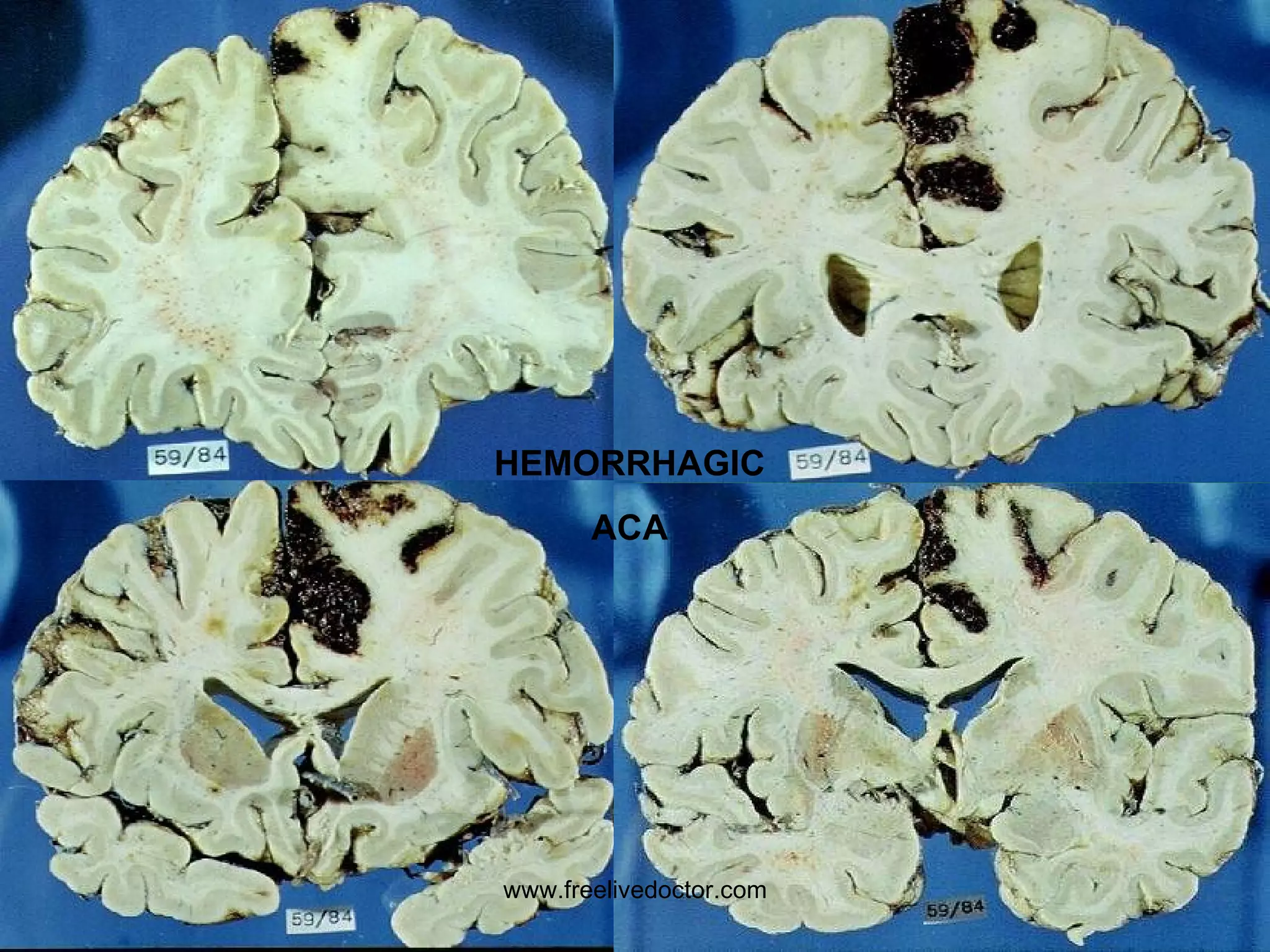 HEMORRHAGIC ACA www.freelivedoctor.com 