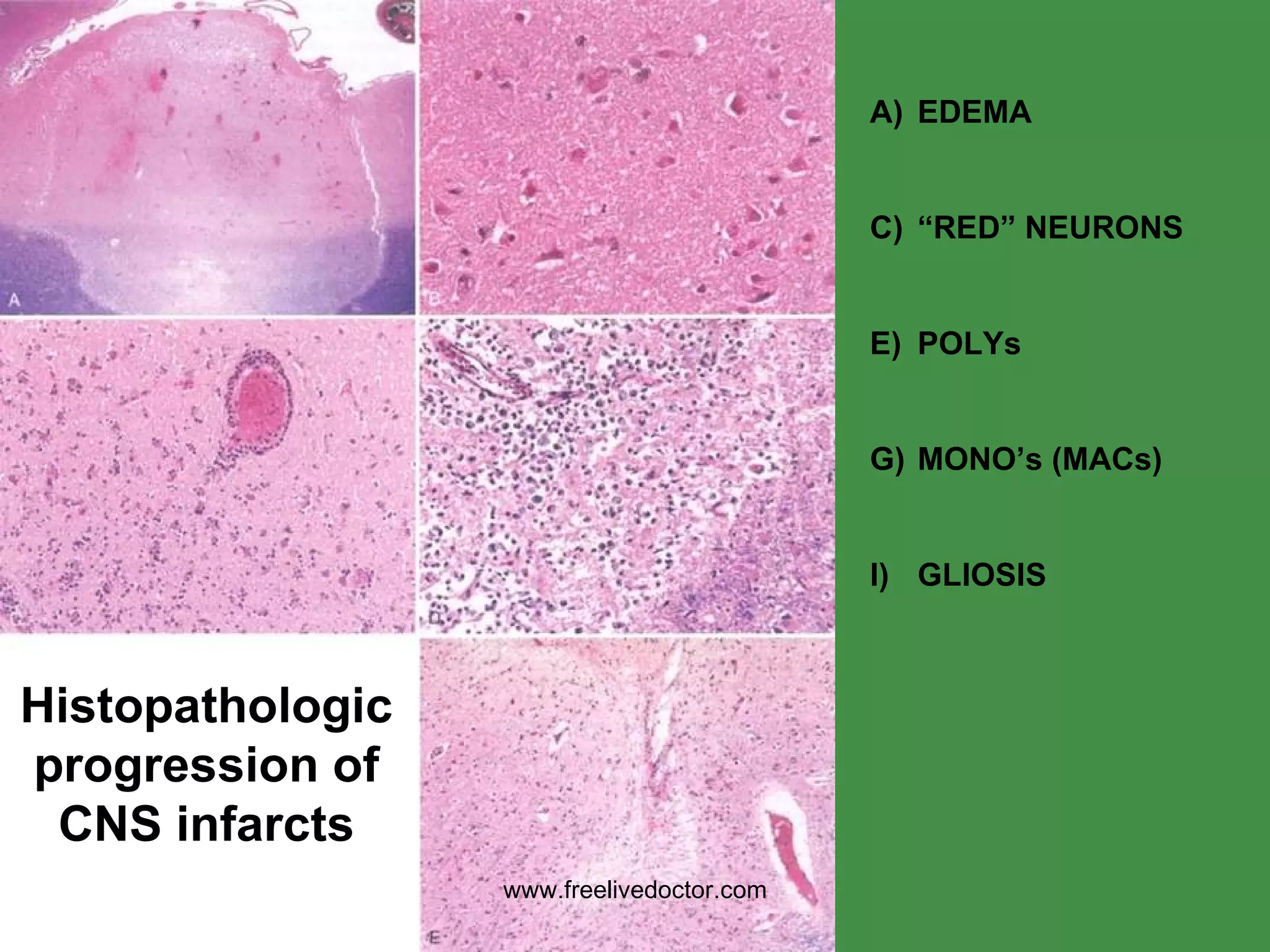 EDEMA “ RED” NEURONS POLYs MONO’s (MACs) GLIOSIS Histopathologic progression of CNS infarcts www.freelivedoctor.com 