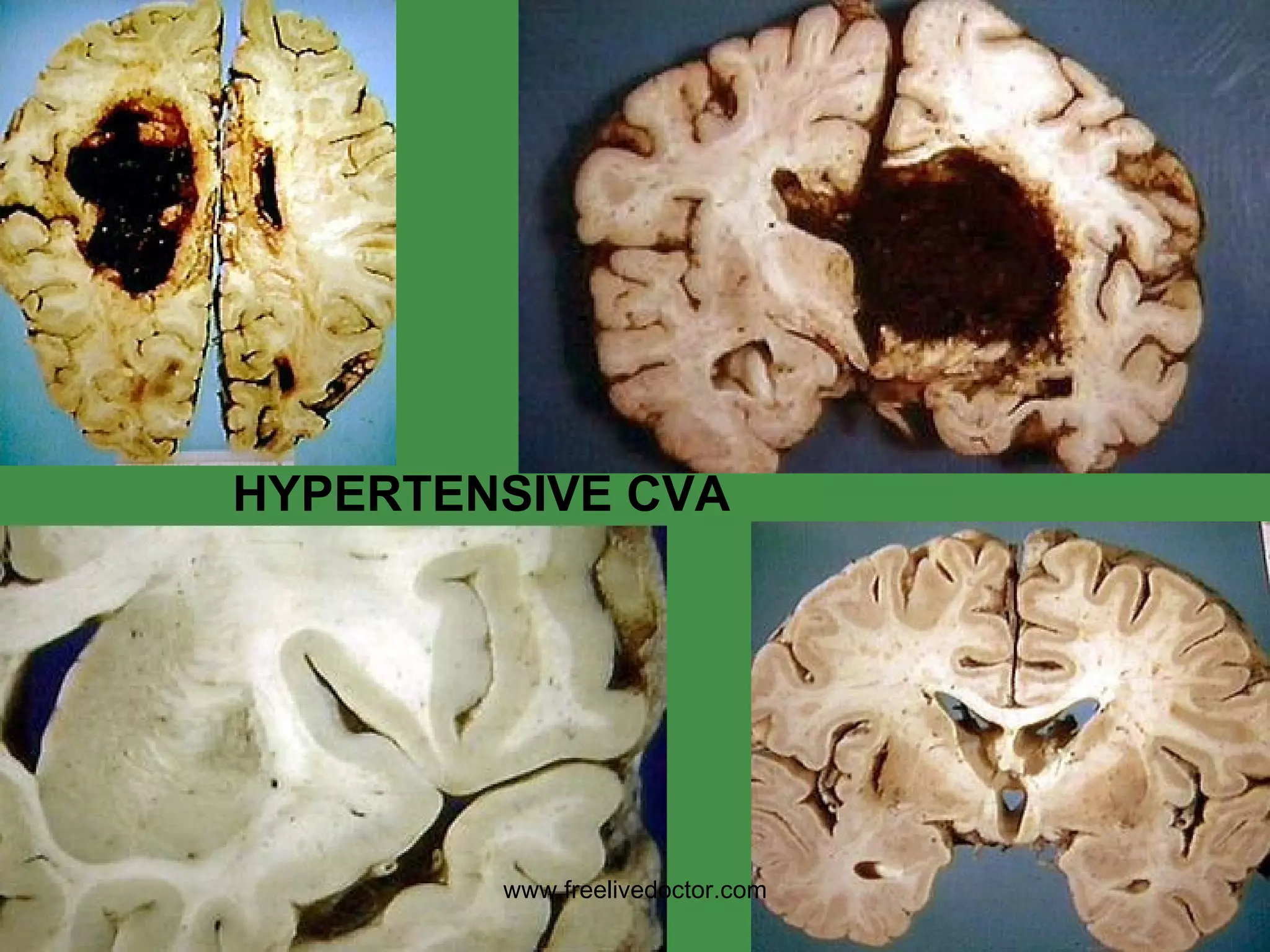 HYPERTENSIVE CVA www.freelivedoctor.com 